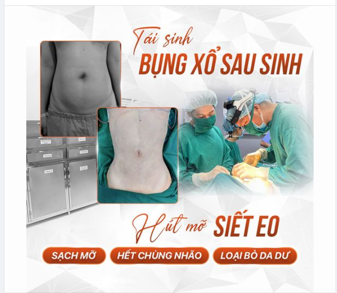 Hút mỡ siết eo đẹp mê ly