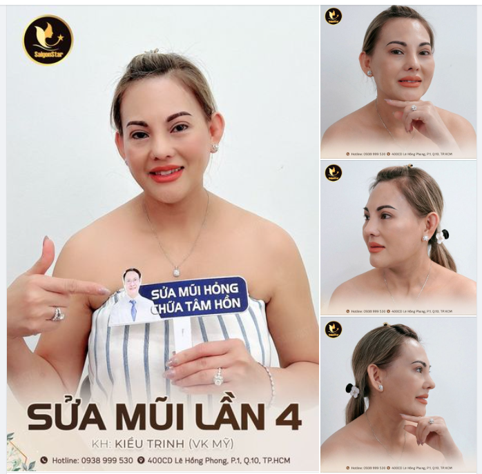 LẦN THỨ 4 SỬA MŨI SẼ NHƯ THẾ NÀO?