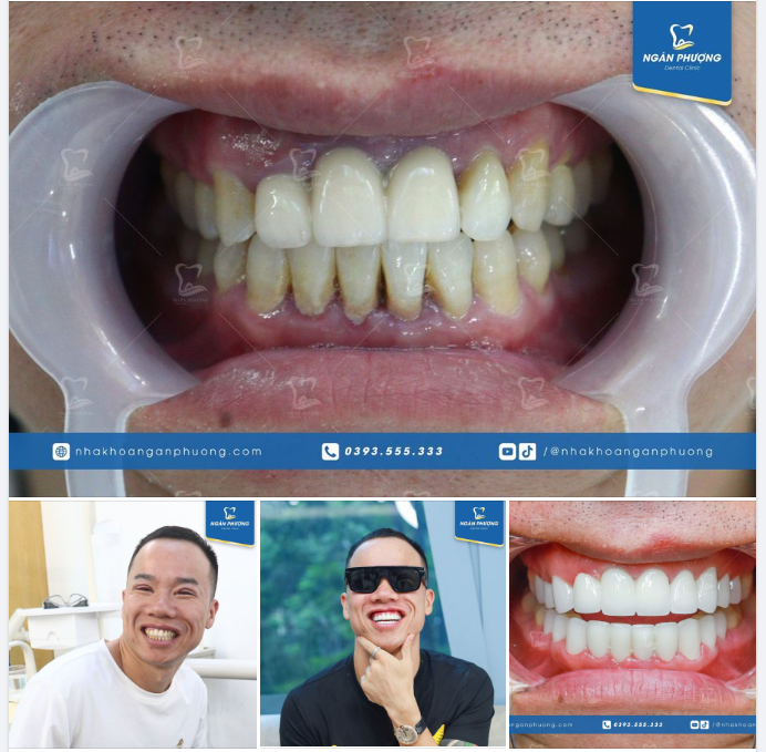 Một anh khách người Trung Quốc biết tới bác sĩ Tuấn qua bạn bè đã quyết định về Việt Nam bọc sứ thẩm mỹ để có nụ cười như ý.