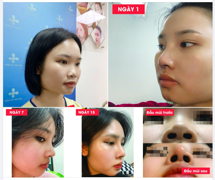 Hành trình 15 ngày nâng mũi của bạn Hương Quỳnh tại Thẩm mỹ Như Hoa.