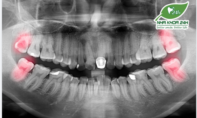 CÓ BẮT BUỘC PHẢI CHỤP PHIM KHI NHỔ RĂNG KHÔN?