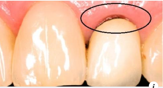 Các dấu hiệu răng sứ bị hở