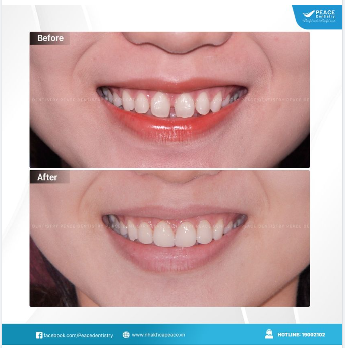 VENEER CHO  RĂNG THƯA  VÌ SAO LÀ CHỈ ĐỊNH PHỔ BIẾN?