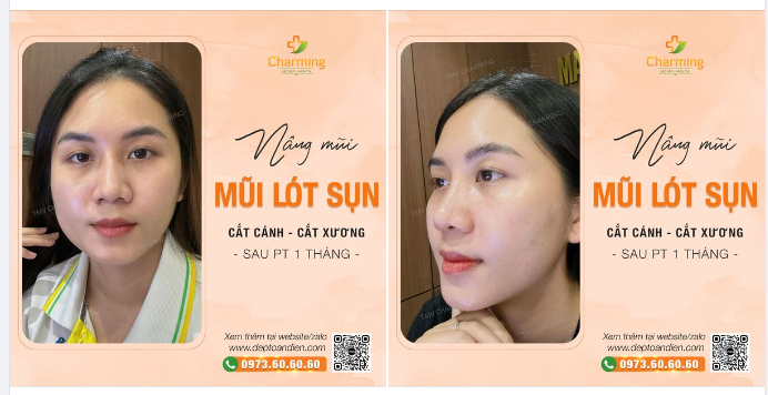Ảnh feedback khách tự trồng cho chiếc mũi lót sụn, cắt cánh, cắt xương cách đây 1 tháng đây ạ  Và Charming vẫn ngày ngày trồng những chiếc mũi xinh-xịn bạn nhé