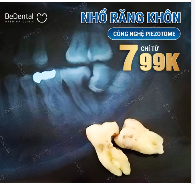 TẠM BIỆT RĂNG KHÔN - CHỈ TỪ 799K