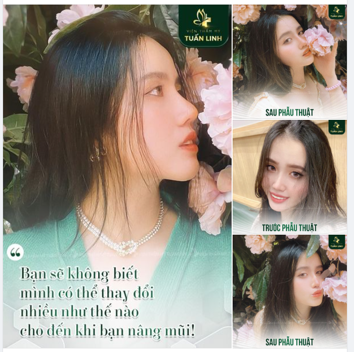Một chiếc mũi cao sẽ thay đổi gương mặt bạn như thế nào??  Click xem ngay hình ảnh bên dưới nha!