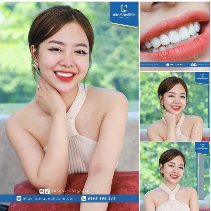 Răng sứ tự nhiên tôn lên nét duyên dáng trong nụ cười