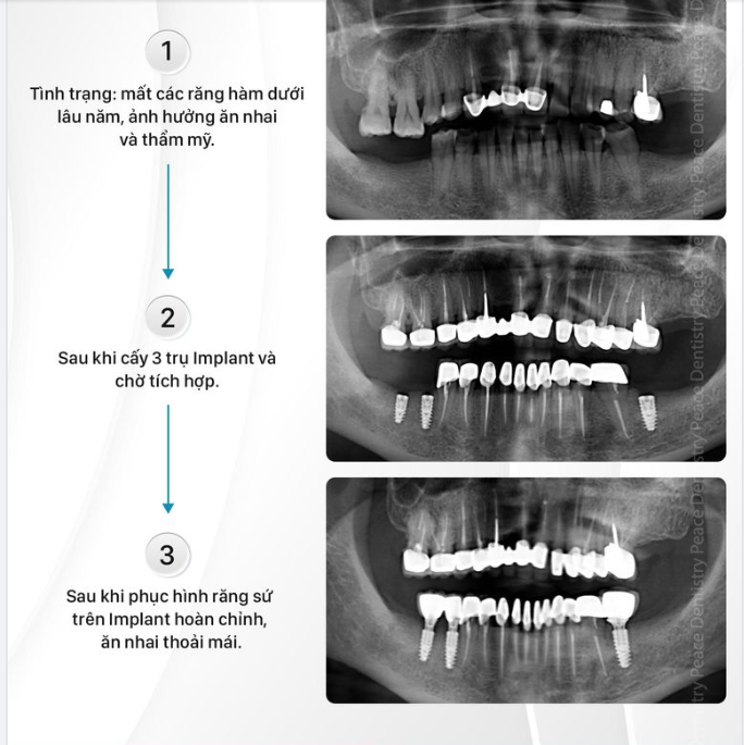 TRỒNG IMPLANT TỪ SỚM MANG LẠI NHIỀU LỢI ÍCH VƯỢT TRỘI