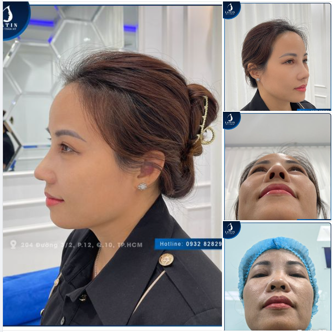 Có ai thấy chị gái nâng mũi xong vừa đẹp vừa sang hơn không ạ!