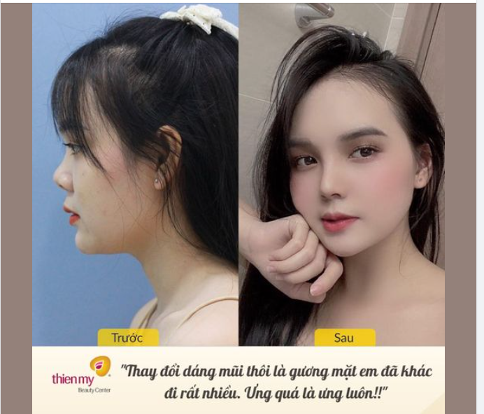 Mục sở thị nhan sắc thay đổi ngoạn mục của chị KH sau khi nâng mũi tại VTM Thiện Mỹ.