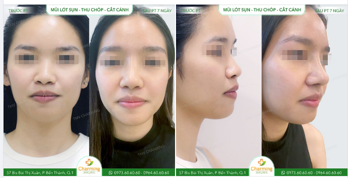 Mũi cũ của bạn khách này không chỉ thấp mà còn lệch hẳn sang một bên so với trục khuôn mặt.