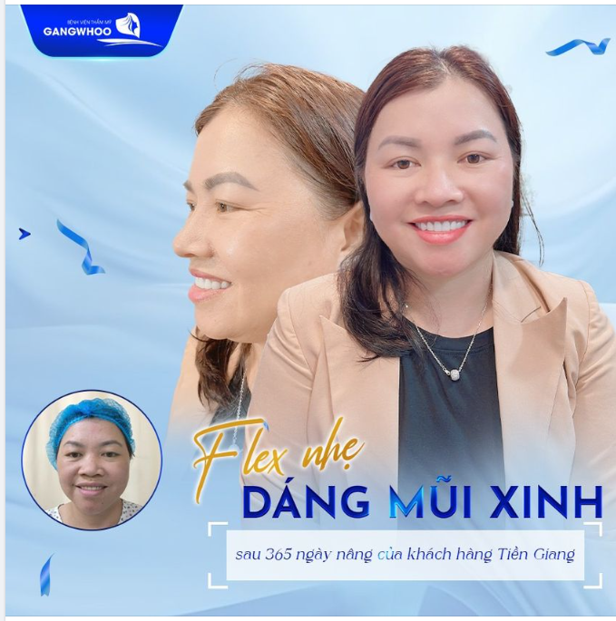Sau 1 năm nâng mũi tại Bệnh viện thẩm mỹ Gangwhoo, chị khách hàng đến từ Tiền Giang đã quay trở lại tái khám và khoe diện mạo xinh đẹp của mình.