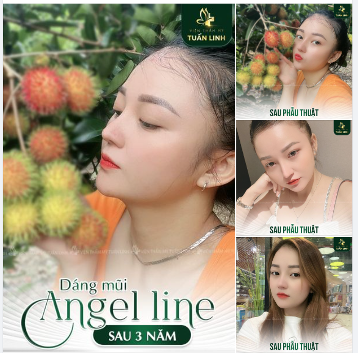 Dáng mũi Angel line tự nhiên sau 3 năm nâng tại Tuấn Linh!!