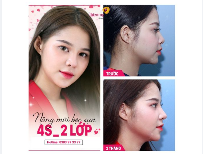 Khoe ngay Feedback xịn xò của KH khi thực hiện nâng mũi tại VTM Thiện Mỹ