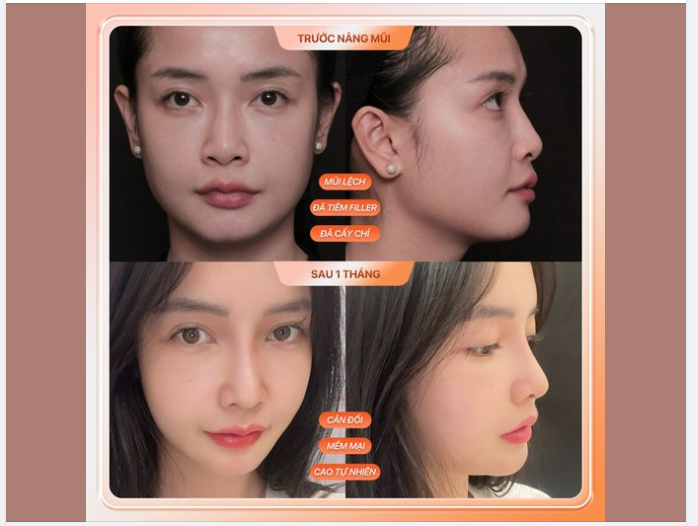 Cũng là sửa mũi nhưng lần này khác lắm