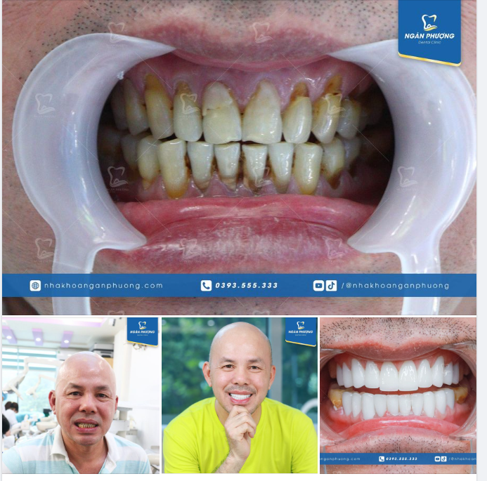 ANH NGUYỄN DŨNG Ở HÀ NỘI ĐẾN VỚI NHA KHOA NGÂN PHƯỢNG