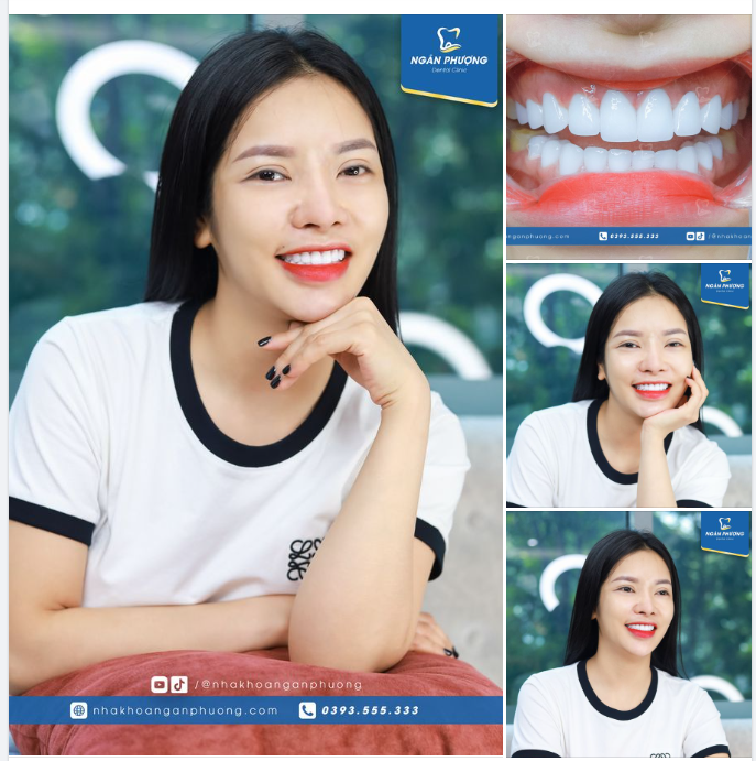 Dáng răng Celeb cực kỳ nổi bật thiết kế riêng cho bạn Ngô Huyền