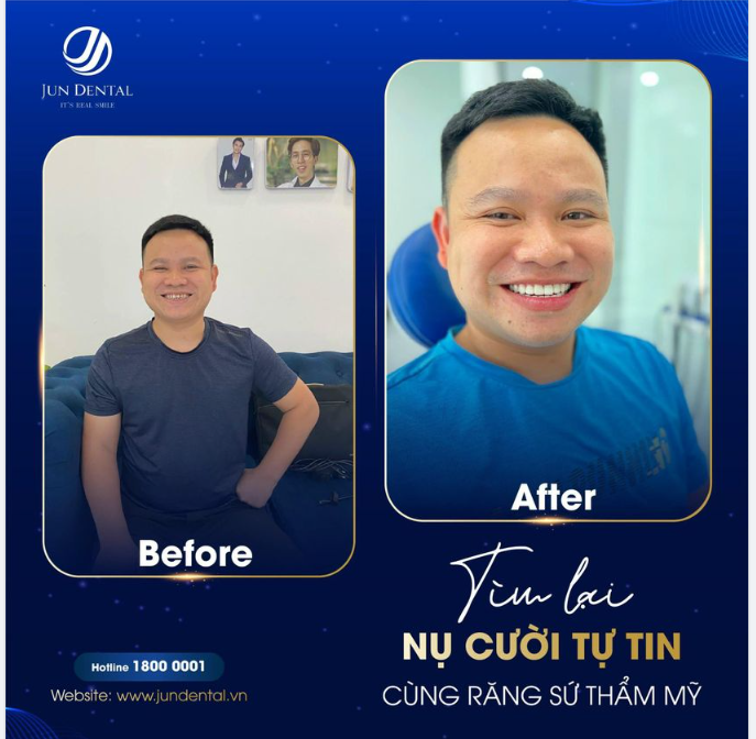 Tìm Lại Nụ Cười Tự Tin, Cùng Răng Sứ Thẩm Mỹ