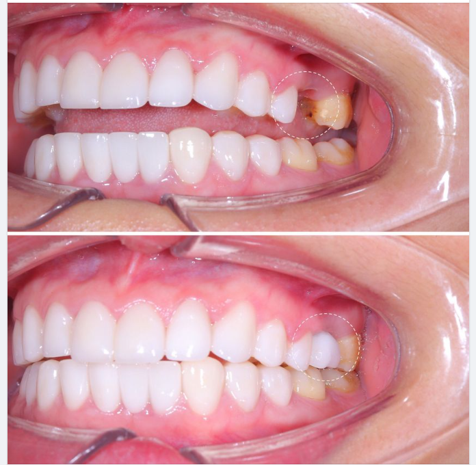 Hoàn thành ca lắp R26 cho chị Dương Thị Mơ- sinh sống tại Thanh Xuân