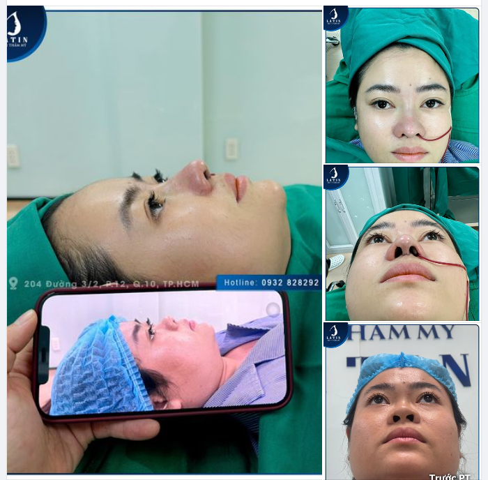 Chỉ sau 60', chị K.Y đã sở hữu dáng mũi mới ưng ý