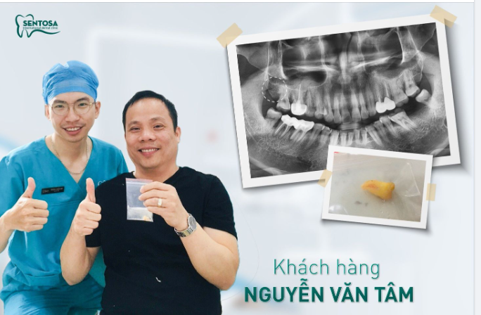 LÝ DO NÊN NHỔ RĂNG KHÔN TẠI SENTOSA