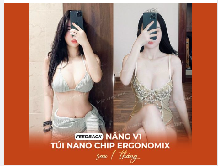 Feedback Nâng ngực cực xinh sau 1 tháng tại DrD Với công nghệ phẫu thuật nội soi nhẹ nhàng: