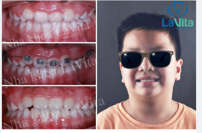 Niềng răng điều trị khớp cắn ngược cho bạn khách hàng của Nha khoa Lavita, chỉ sau 4 tháng đã cho kết quả vô cùng kì diệu