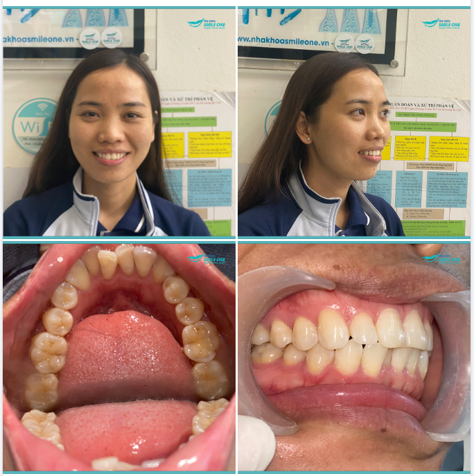Smile One chúc Hiên sớm về đích trên hành trình niềng răng của mình nhé!