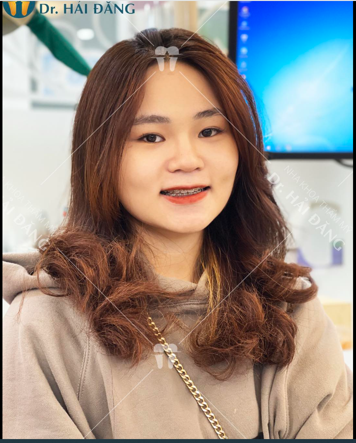 Chúc mừng bạn niềng răng thành công tại Nha Khoa Hải Đăng ngày hôm nay!