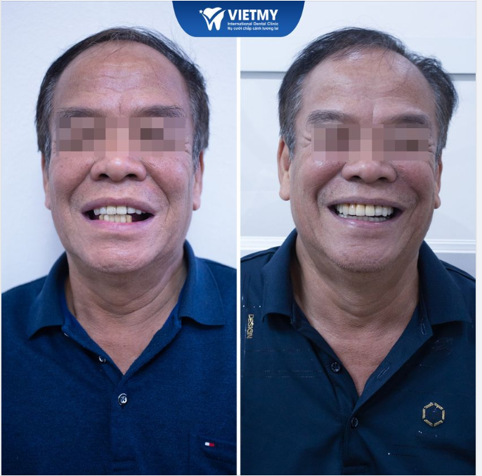 CẢI THIỆN SỨC KHỎE, TUỔI GIÀ TRỌN VẸN NHỜ TRỒNG RĂNG IMPLANT