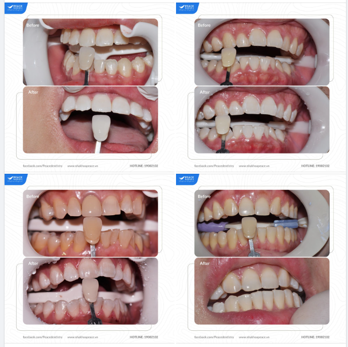 CÔNG NGHỆ TẨY TRẮNG RĂNG TẠI PEACE DENTISTRY