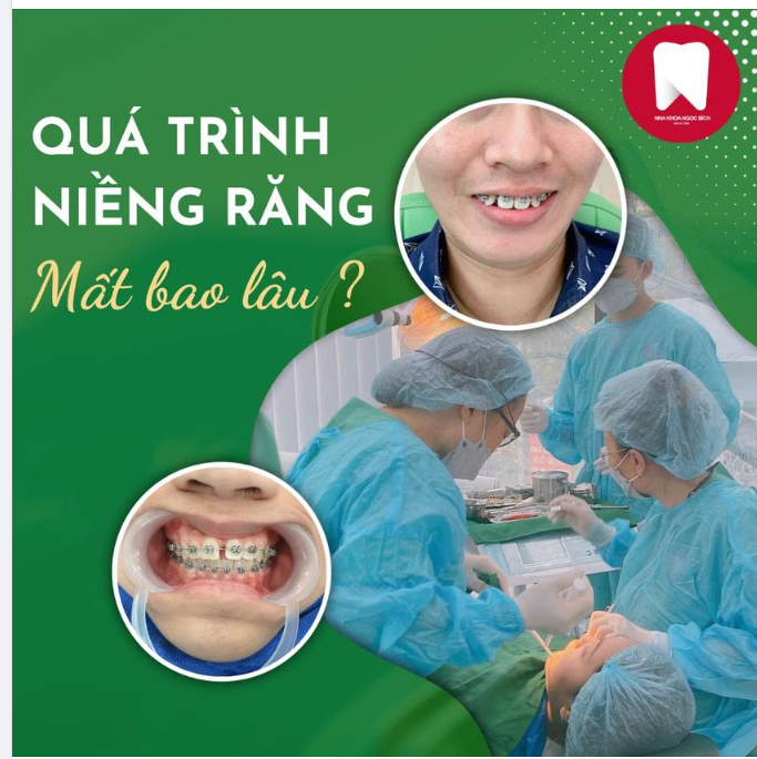 QUÁ TRÌNH NIỀNG RĂNG MẤT BAO LÂU