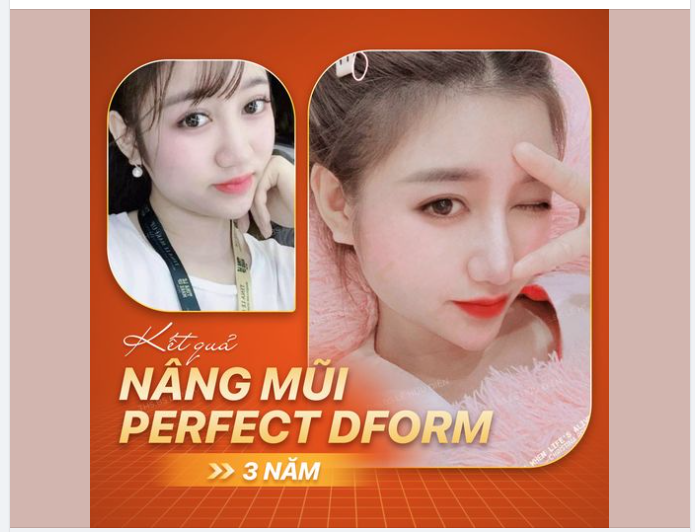 Cận cảnh kết quả nâng mũi sau 3 năm