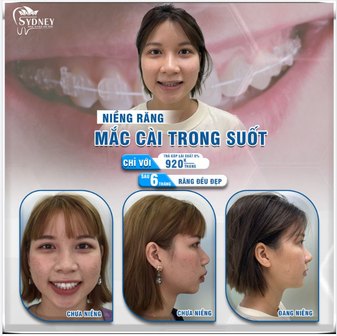 NIỀNG RĂNG MẮC CÀI TRONG SUỐT – HIỆU QUẢ CAO, THẨM MỸ TUYỆT VỜI