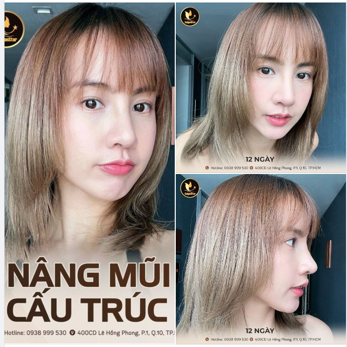 SỨC MẠNH CỦA NÂNG MŨI CẤU TRÚC