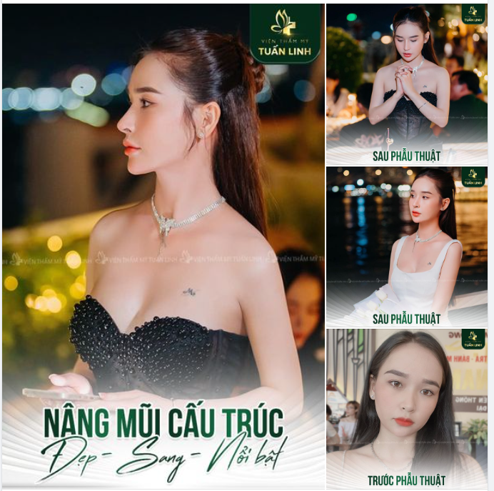 Nâng mũi cấu trúc - Thiết Kế Dáng Mũi Đẹp - Sang - Tự nhiên - Hiệu Quả Bền Lâu!