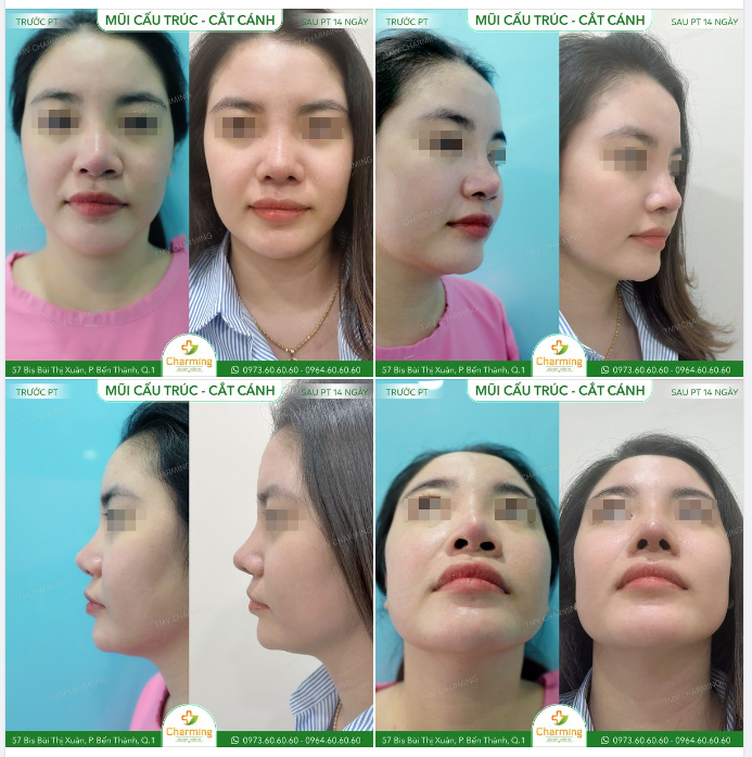 Nếu mọi người vẫn chưa hình dung ra được công dụng đáng ngạc nhiên của nâng mũi cấu trúc thì nàng khách sau đây của Charming sẽ là ví dụ trực quan cho mọi người.