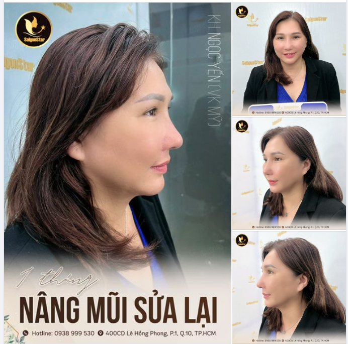 1 THÁNG NÂNG MŨI SỮA LẠI