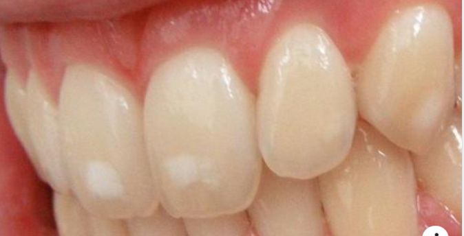 Thế nào là răng nhiễm fluor?