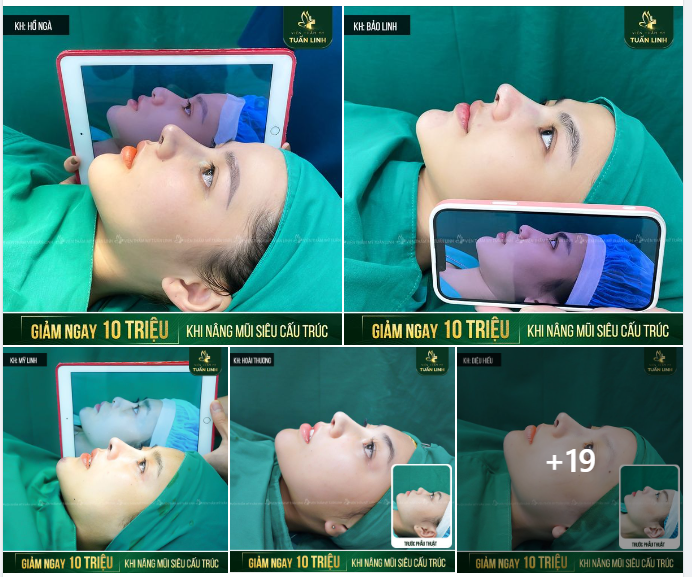 TIN ĐƯỢC KHÔNG: GIẢM 10TR KHI NÂNG MŨI CẤU TRÚC