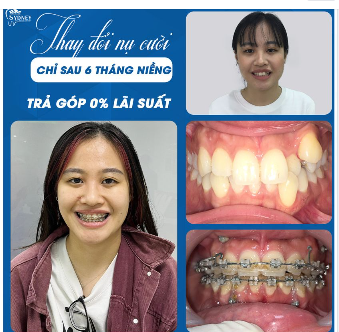 NIỀNG RĂNG HÔM NAY CHO TƯƠNG LAI TƯƠI SÁNG