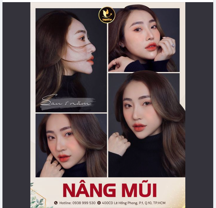 SAU 5 NĂM NÂNG MŨI DR. HOẠT MŨI THỜI THƯỢNG – DÁNG CAO SANG