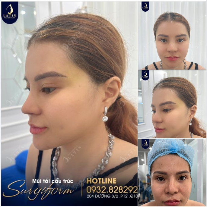 Mũi tái cấu trúc sụn sườn, chỉnh vách ngăn, sóng Surgiform cho chị gái sau 10 ngày.