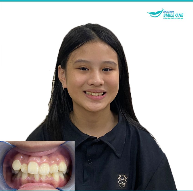 Chào mừng bạn Nguyễn Vũ Hà Linh đã đến với Team niềng răng Smile One cơ sở Giáp Nhất.
