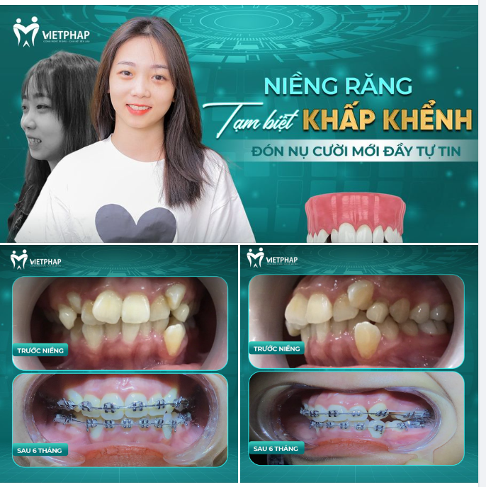 NIỀNG RĂNG TẠM BIỆT KHẤP KHỂNH, ĐÓN NỤ CƯỜI MỚI ĐẦY TỰ TIN
