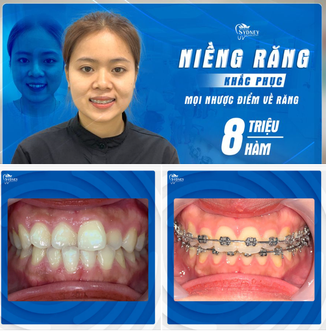 LÝ DO NÊN LỰA CHỌN NIỀNG RĂNG MẮC CÀI KIM LOẠI