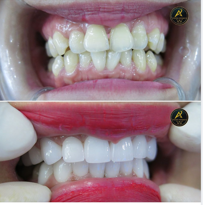 Các Vấn Đề Thường Gặp Sau Khi Trồng Răng Sứ Và Cách Khắc Phục