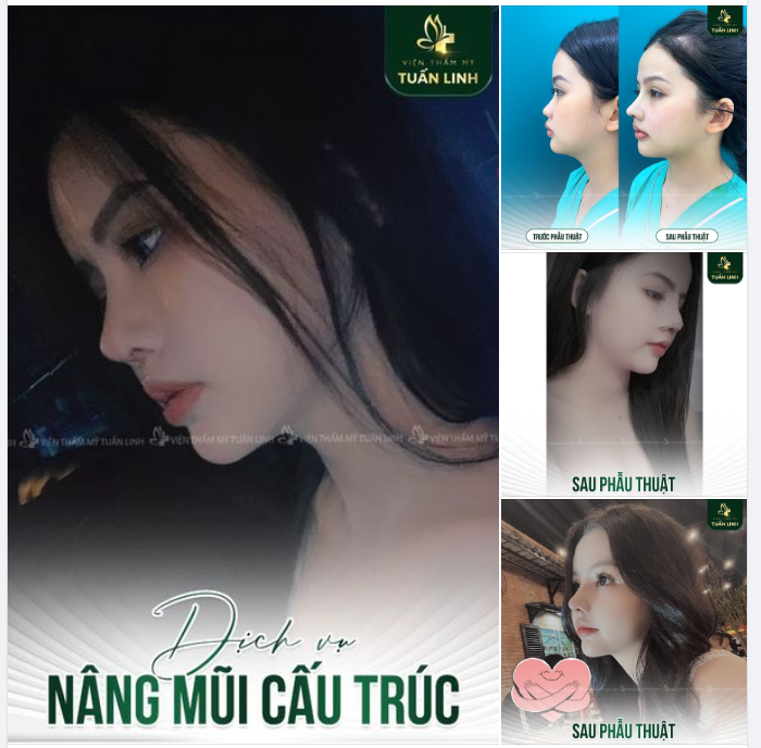 Đẹp mĩ mãn với dáng mũi cấu trúc nhà Tuấn Linh.