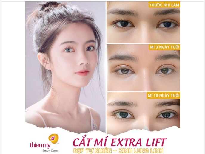 Kết quả sau 10 ngày cắt mí tại Thiện Mỹ có xứng đáng với điểm 10 không cả nhà?