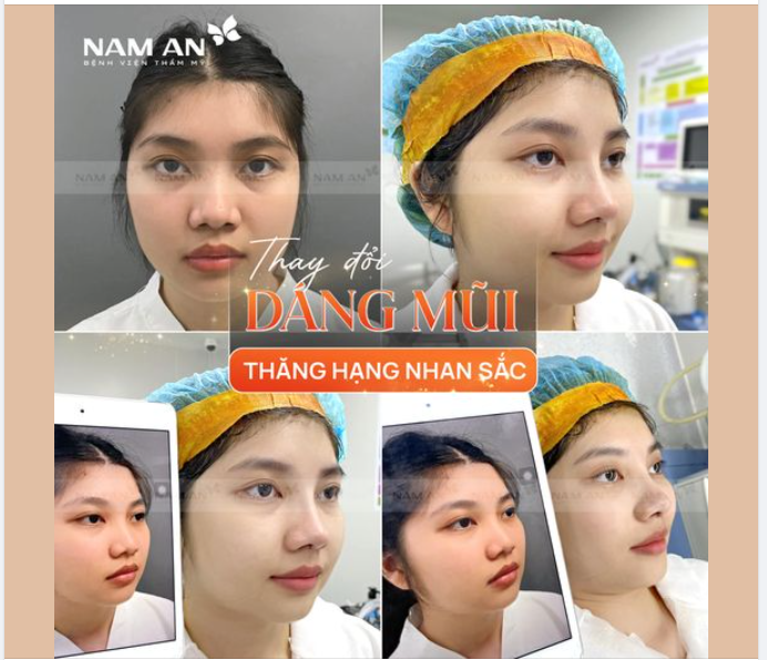 THĂNG HẠNG NHAN SẮC - NGAY SAU NÂNG MŨI